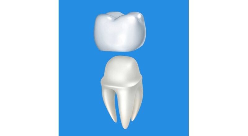 Установка металлокерамической коронки