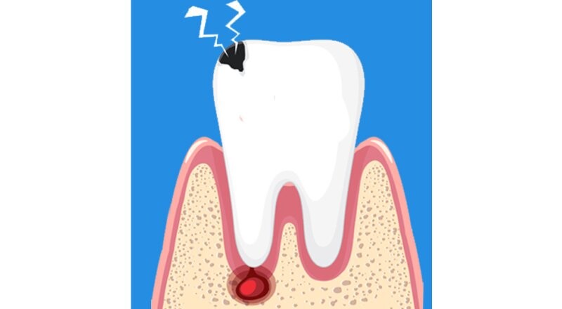 Лечение пульпита